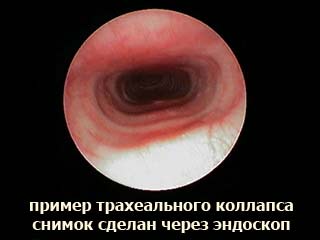 Эндоскопия позволяет визуализировать дыхательное горло 