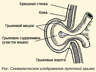 Схематическое изображение пупочной грыжи у чихуахуа 