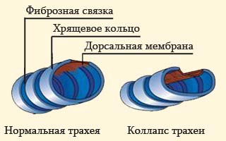 Наглядный пример трахеи с коллапсом и без 