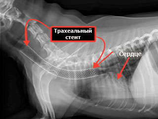 Стент вводится и устанавливается в полость дыхательного горла 